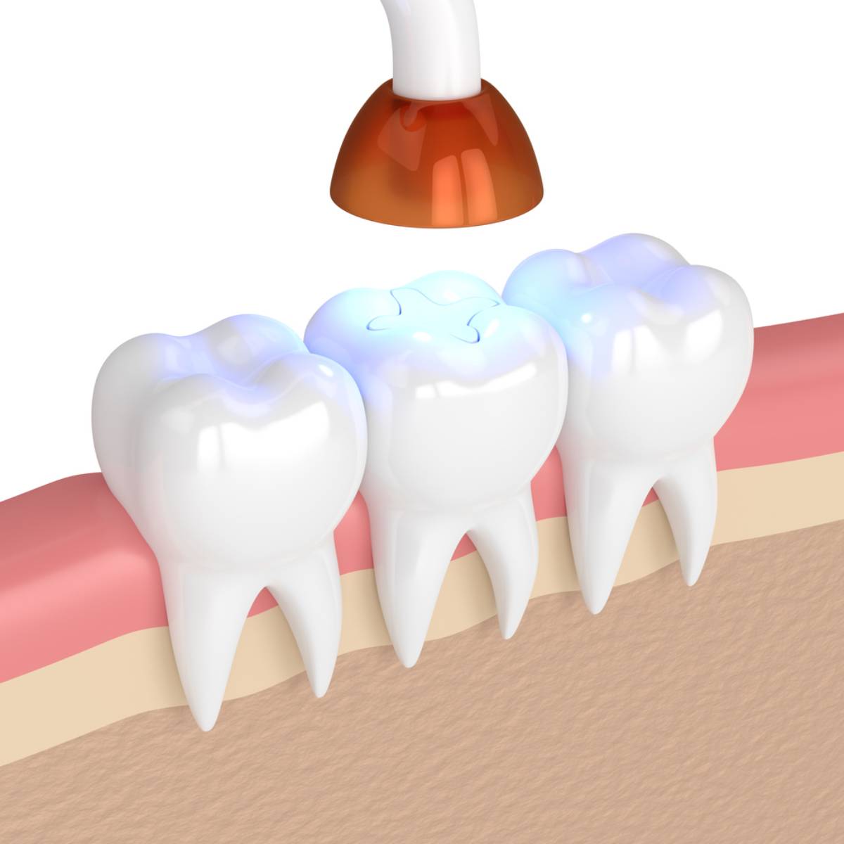 featured image for pros and cons of composite fillings